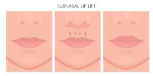 Subnazal Lip lift