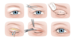 Üst Göz Kapağı Ameliyatı Nasıl Yapılır?