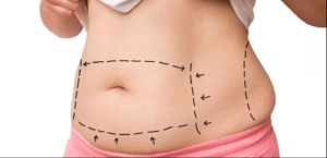 Liposuction kaç beden inceltir?