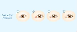 Badem Göz Ameliyatı