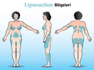 Liposuction bölgeleri