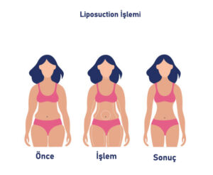 Liposuction işlemi