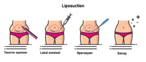 Liposuction - lokal anestezi