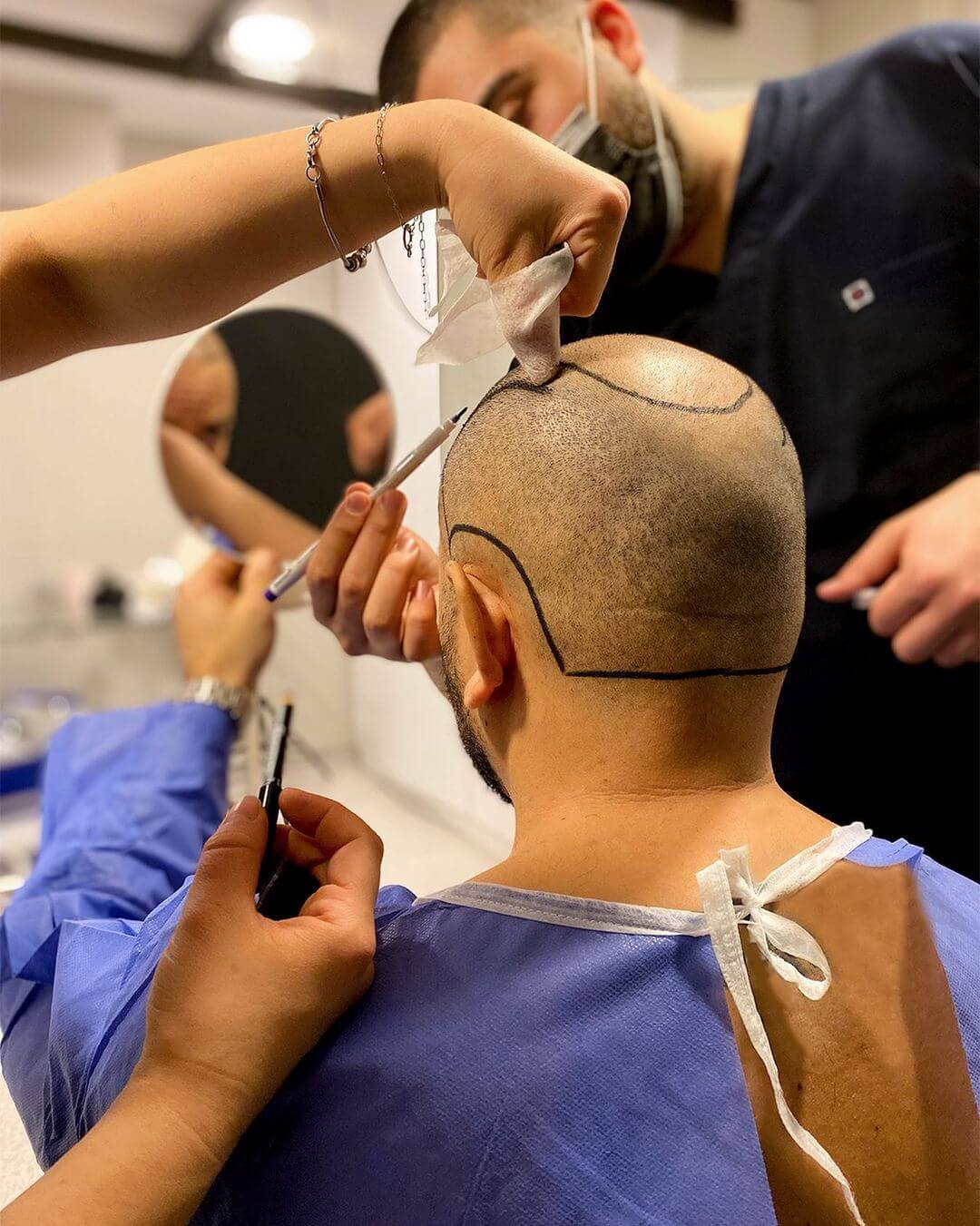 DHI - Hair Transplant