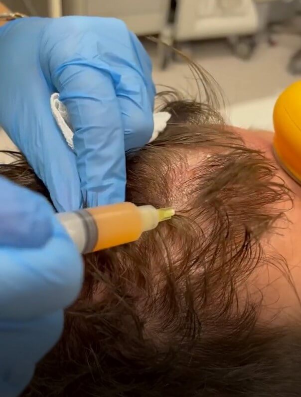 Hair Loss Mesotherapy