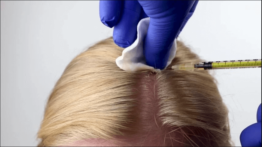 Hair Loss Mesotherapy
