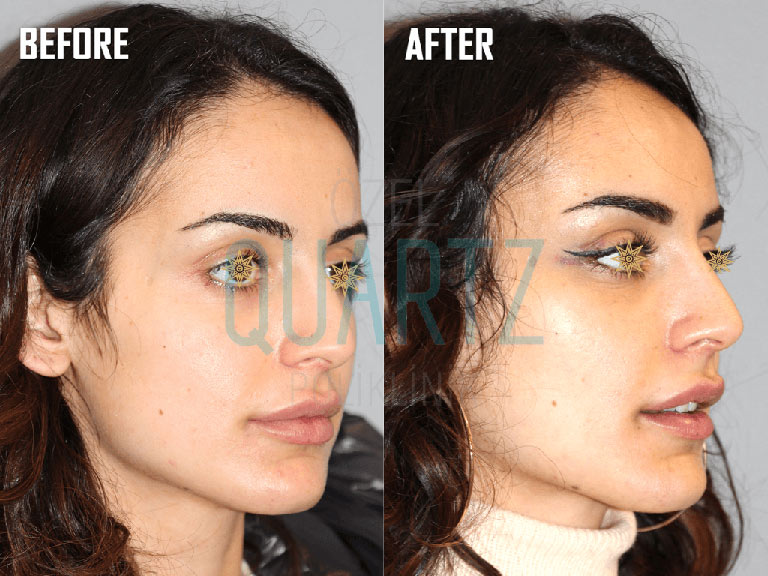 Eyebrow Thread Lift  Costs, Duration and Side Effects - Rahya Clinic