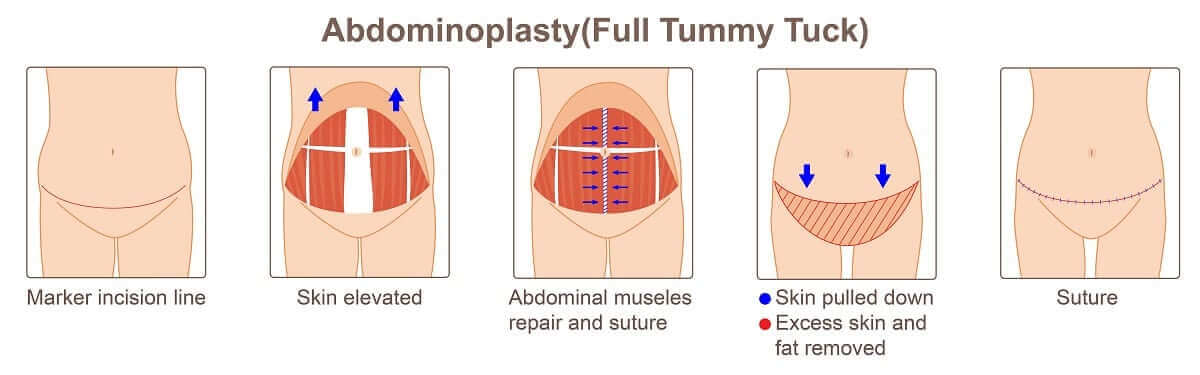 Karın Germe Ameliyatı (Abdominoplasti) Nasıl Yapılır