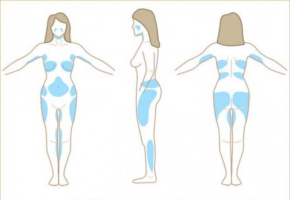 Liposuction Hangi Bölgelere Uygulanır