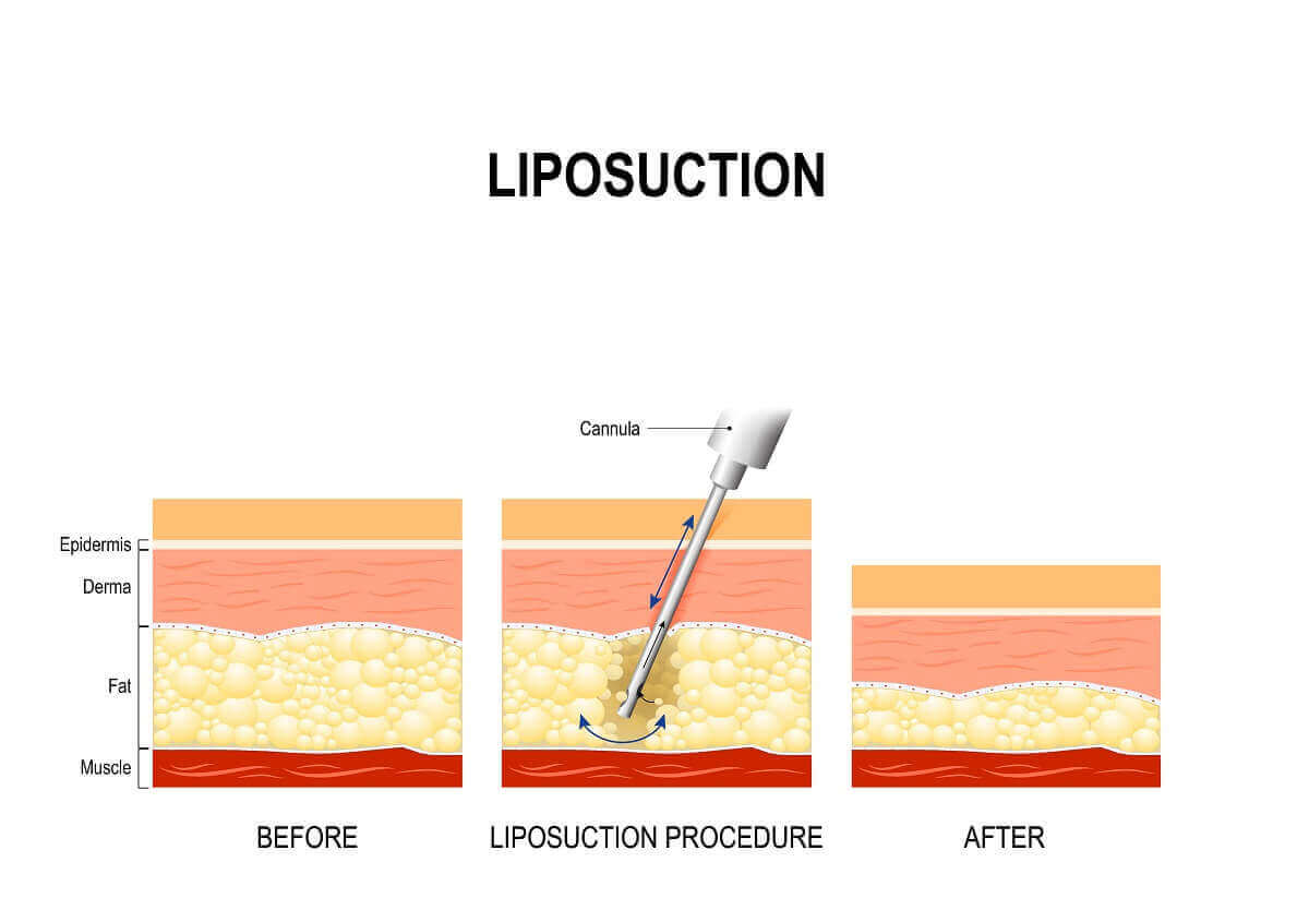 Liposuction Nedir
